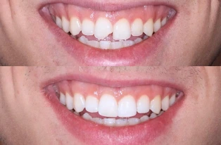 Broken tooth repair